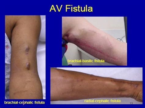 fistulae|Fistulas .